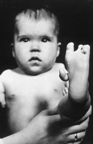 Thalidomide birth defect